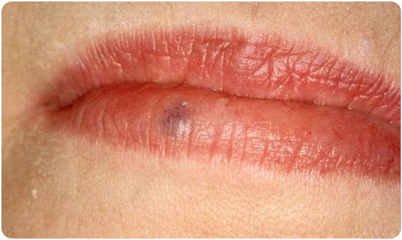 Can Red Spot on Lip Be Cancer? — Scary Symptoms