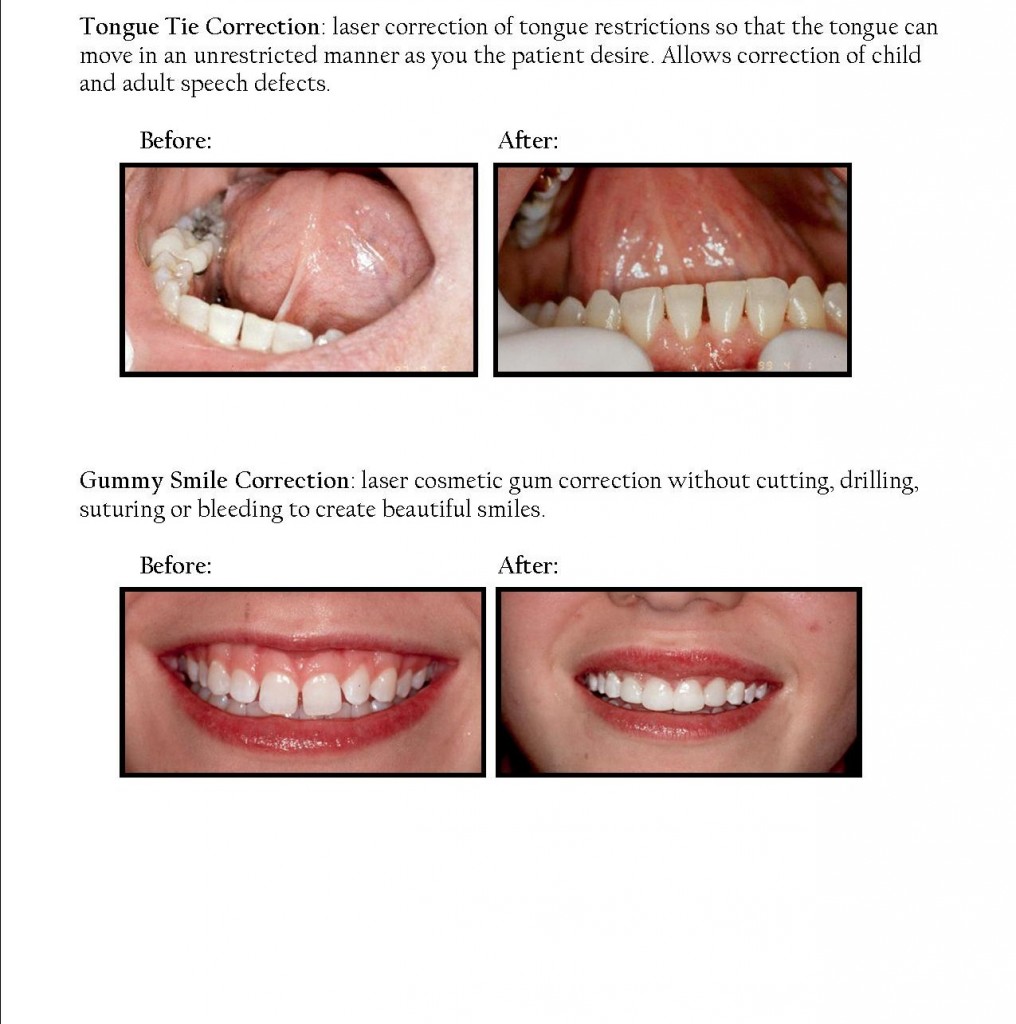 Cosmetic Laser Surgery Tongue Tie And Gummy Smile Correction