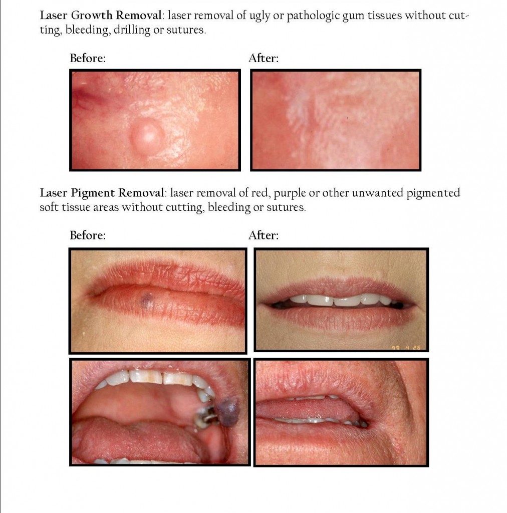Laser Growth and Pigment Removal