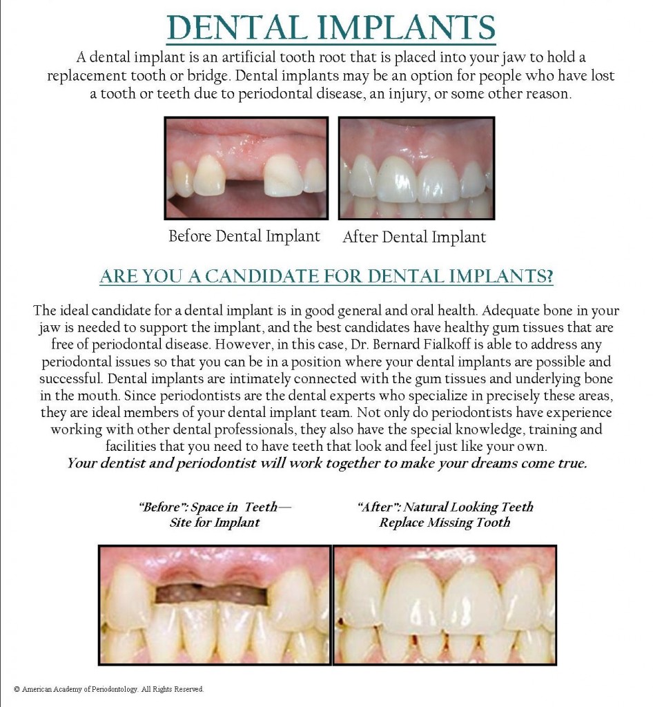 Dental Implants Procedure Before and After