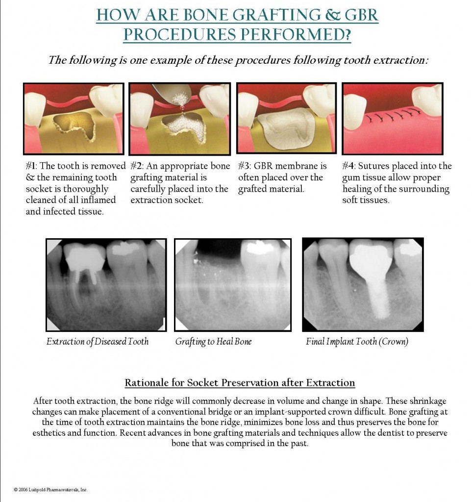 How Are Bone Grafting And GBR Procedures Performed