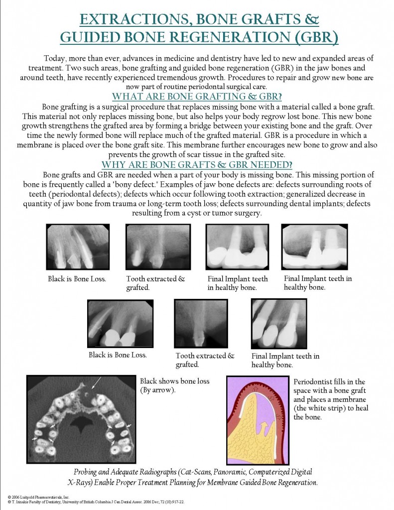 Extractions, Bone Grafts & Guided Bone Regeneration Procedure At Bayside dentist