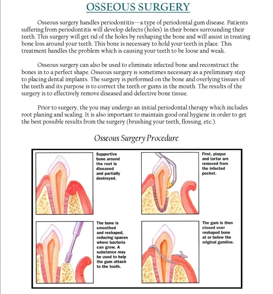 Osseous Surgery Procedure