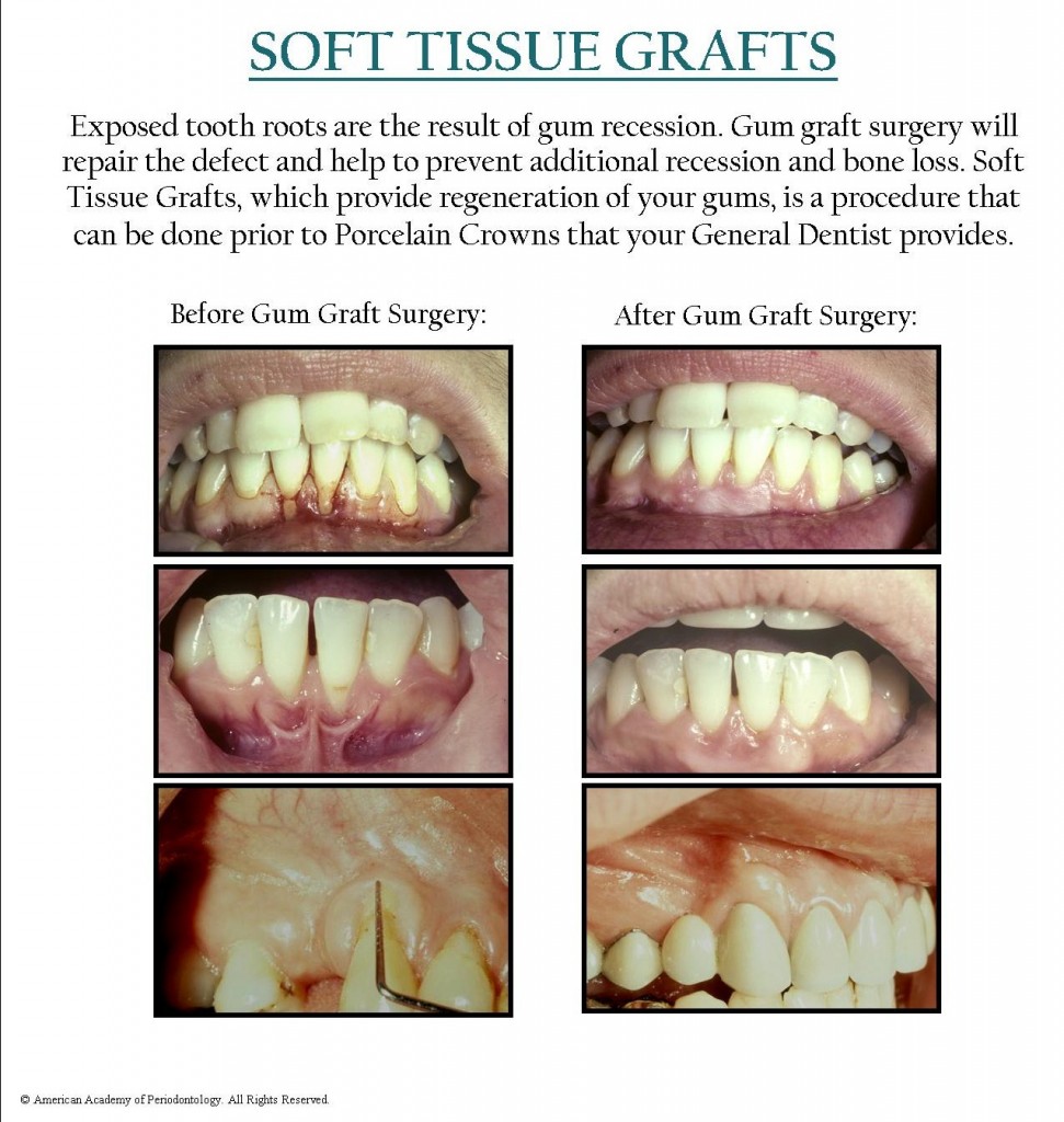 Soft Tissue Grafts