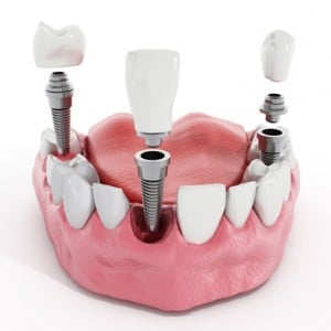 what should you know about dental implants first