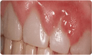 After Laser Swollen Gum Correction - Bayside Dental Implants