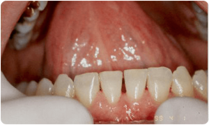After Laser Tougue Tie Correction - Bayside Dental Implants