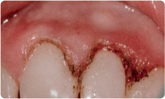 Before Laser Swollen Gum Correction - Baysidedentist.com
