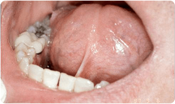 Before Tongue Tie Correction Procedure At Bayside Dentist, NY
