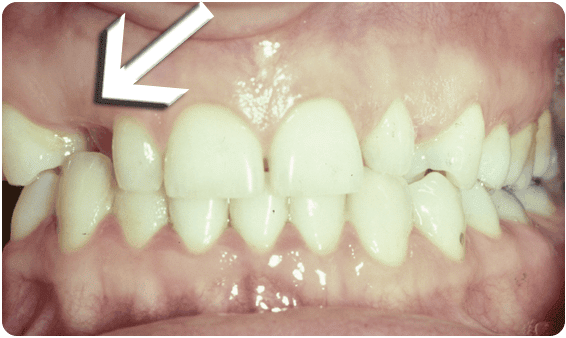Before Tooth Exposure Procedure At Bayside Dentist, NY