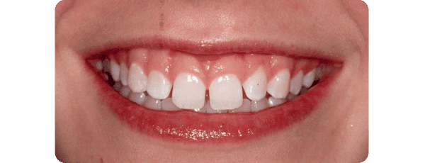 Before Gummy Smile Correction At Bayside Dentist, NY