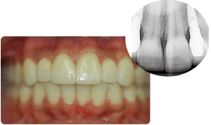 Implants Teeth - Baysidedentist.numberoneonthelist.com