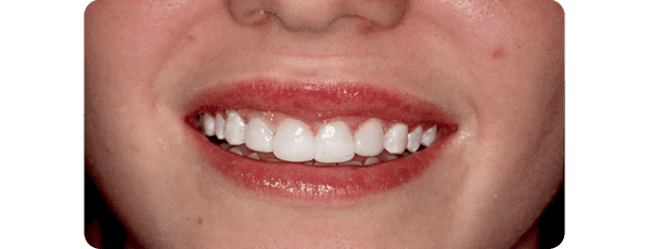 After Gummy Smile Correction At Bayside Dentist, NY