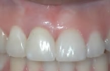 After Bayside Queens Dental Implants