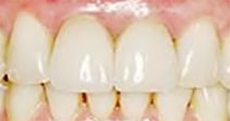 After: Natural Looking Teeth Replace Missing Tooth