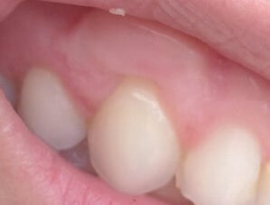 After Gum Graft Surgery - Bayside Dental Implants