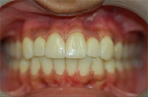 Beautiful Smile After - Bayside Dental Implants