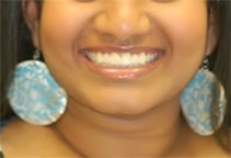 Beautiful Smile After Bayside NY Dental Implants