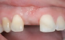 Before Dental Implants Bayside