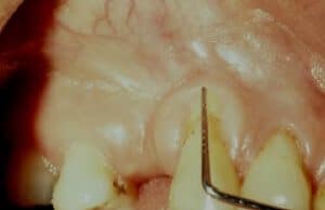 Before Gum Graft Surgery - Bayside Dental Implants