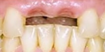 Before: Space in Teeth—Site for Implant