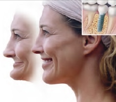 Bone Loss, Speech Problems, and Facial Changes Are Consequences of Missing Teeth