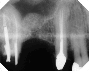 Graft starting, decayed tooth removed