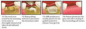 procedure following tooth extraction - Baysidedentist.com