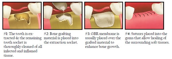 Bone Graft And GBR Procedure After Tooth Extraction