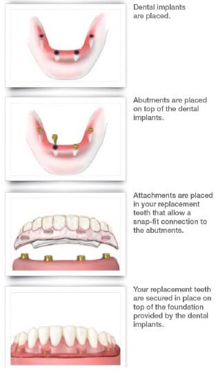 Overdentures Procedure At Bayside Dentist, NY