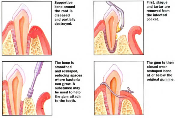 Osseous Surgery Procedure At Bayside Dentist