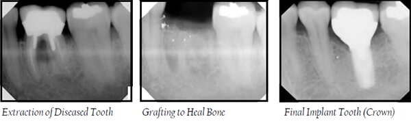 Extraction, Grafting, And Final Tooth Implant