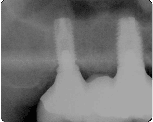 Successful sinus graft supporting implant teeth