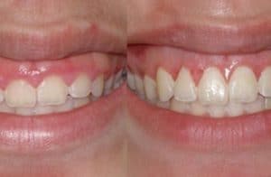 Tooth lengthening