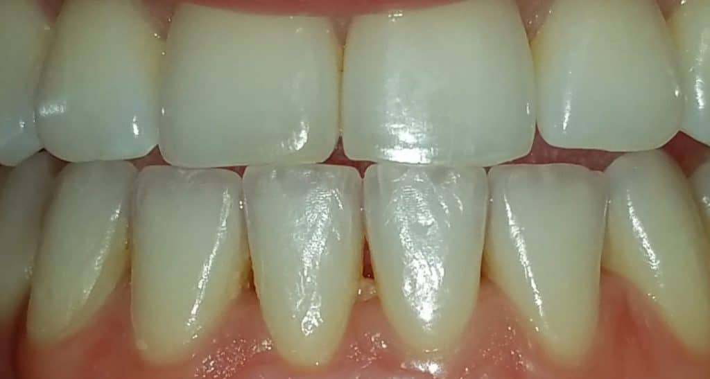 Periodontal Maintenance After
