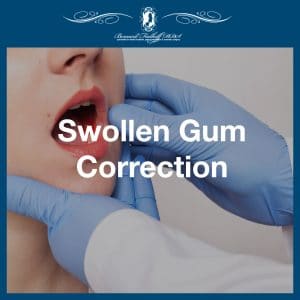 Swollen Gum Correction featured image