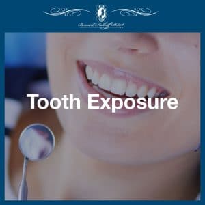 Tooth Exposure featured image