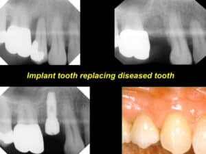 dental implants