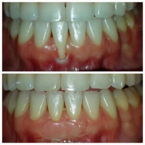 soft tissue regeneration