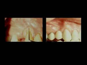 soft tissue regeneration