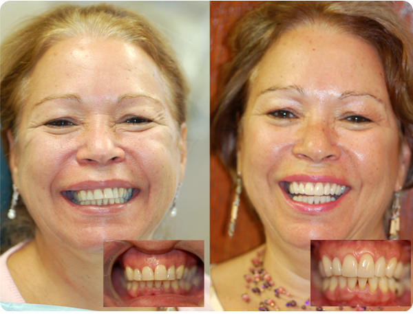A before and after picture of someone who got a smile make-over. Her teeth appear whiter and healthier in the after picture